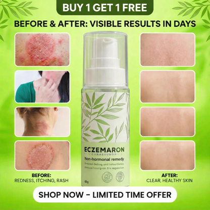 Eczemaron Anti-Fungal & Itch Relief Spray | 100% Safe | Buy 1 Get 1 FREE 🔥🔥